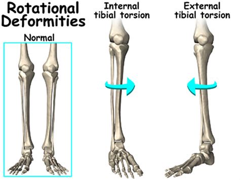 tibial torsion pictures